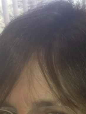 אחרי עיבוי שיער