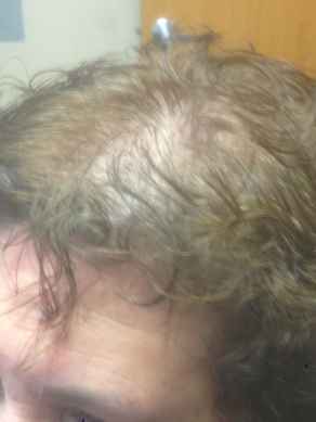 לפני מילוי שיער