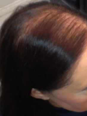 לפני מילוי שיער דליל במיוחד